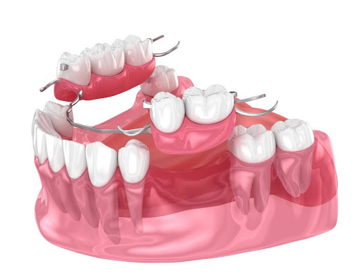 Caring for Your Partial Denture